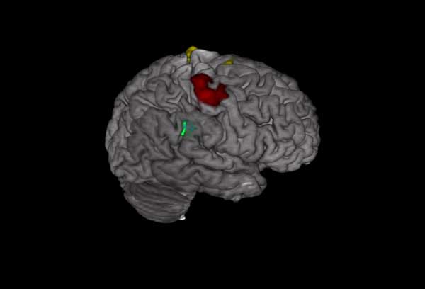Functional MRI (fMRI)