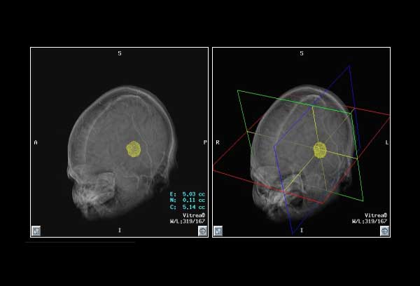 CADx:
Brain Tumor Volume 