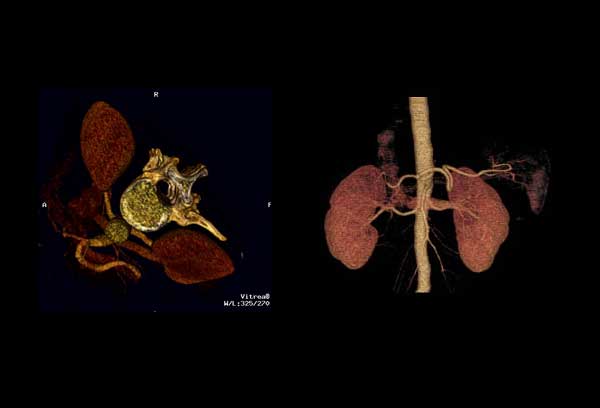 CT Angiography (CTA) 
