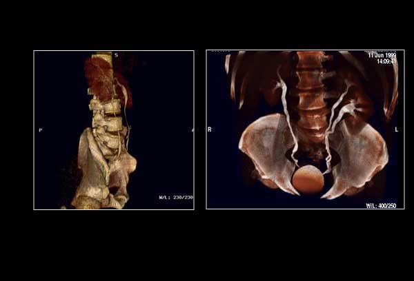 CT Urography (CTU) 