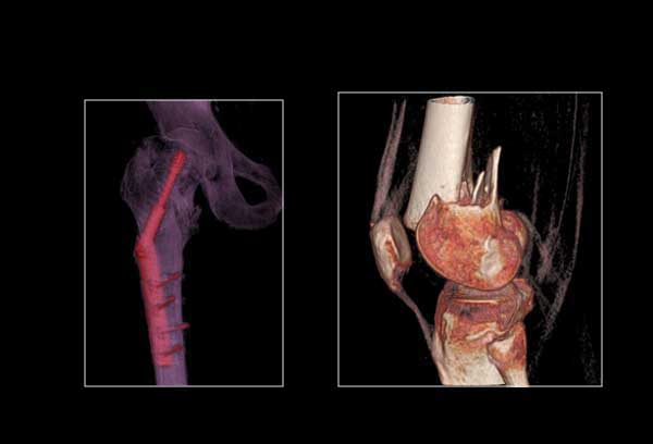 Orthopaedics: 
Volume Rendering (VR)