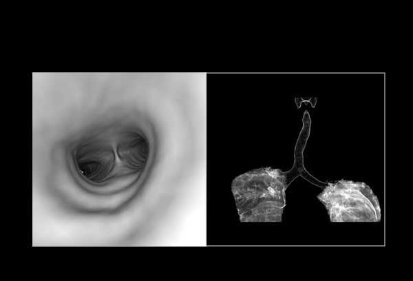 CT Bronchography)