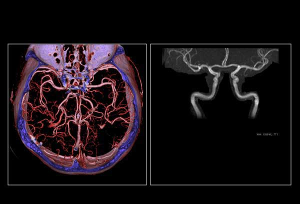 Neurovascular CTA/MRA)